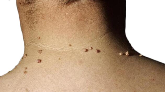 Papillomas in the neck are the result of the defeat of the virus
