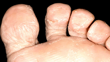 How to recognize the presence of a fungus between toes
