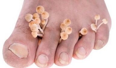 Reasons for the development of fungus between toes