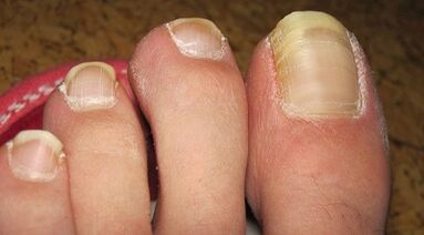 How to show herself in the nail mushrooms