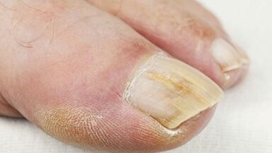 Initial stage of development of mushrooms in the nail