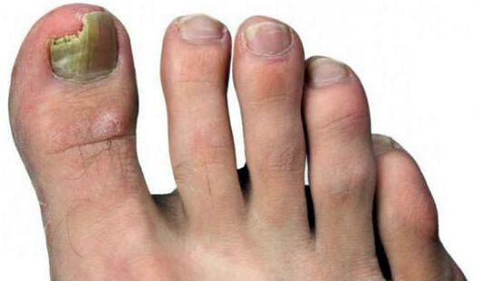 The rocking of nail