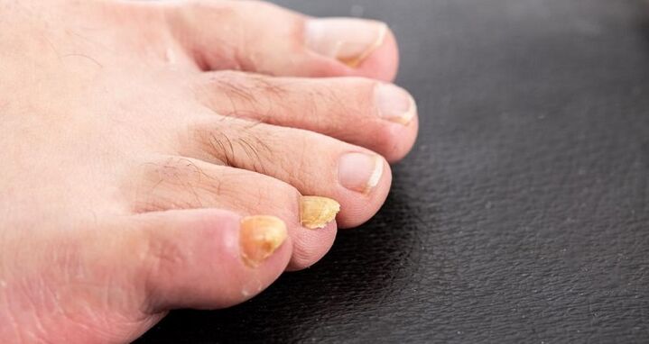 yellowing of nails due to athlete's foot