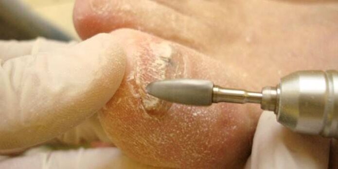 removal of fungal nails