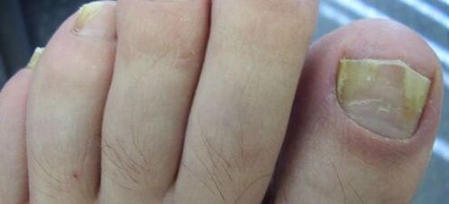 Nail fungus symptoms and treatment with vinegar