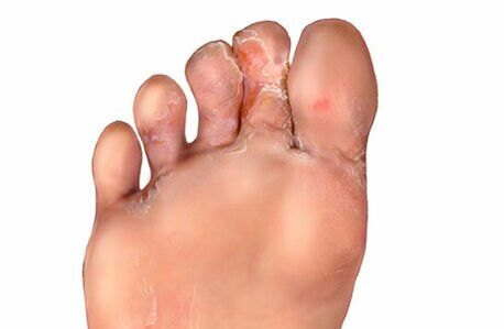 signs of fungus between the toes