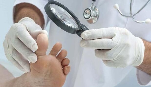 Diagnosis of fungus