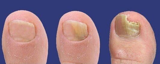 Development of fungi on toenails