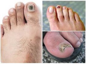 Symptoms of fungal nail infection