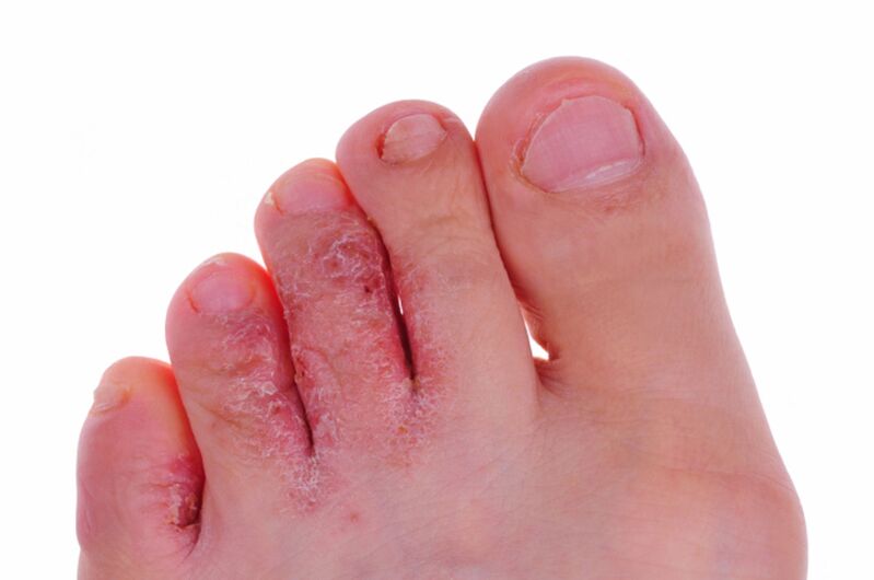 Symptoms of rubrophytosis - cracks and scales on the skin of the feet