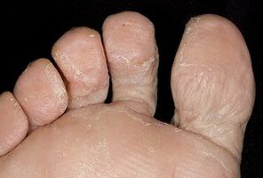 The skin of the feet with a fungal infection