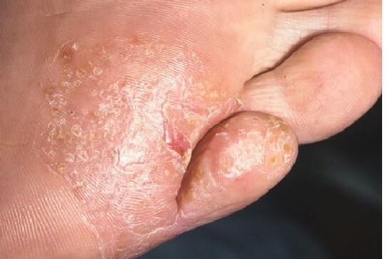 Manifestations of fungal infection on the skin of the foot