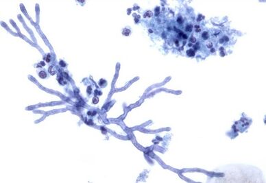 Mold mushrooms that affect the nail plate