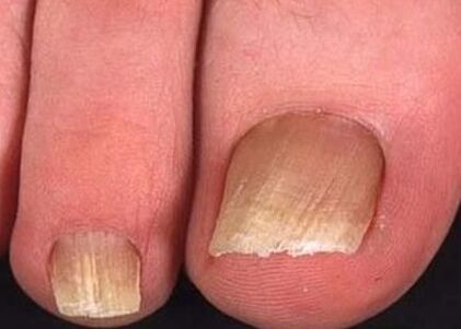Nail mushrooms on the legs of the initial stage