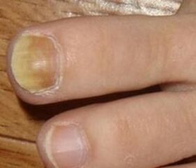 Symptoms of the initial stage of nail fungi